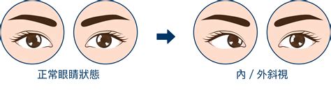 眼睛斜視|斜視：成因、病徵及治療